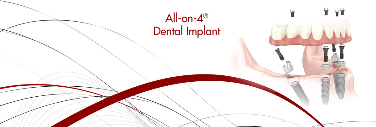 Pomona All-on-4 Dental Implants