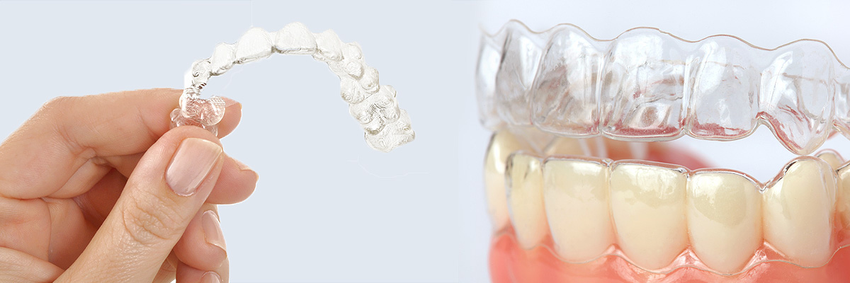 Pomona Alternative to Braces for Teens