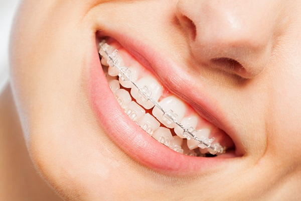 How To Care For New Clear Braces