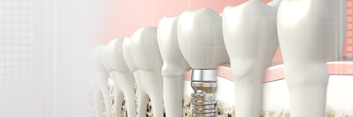 Pomona Tooth Colored Fillings