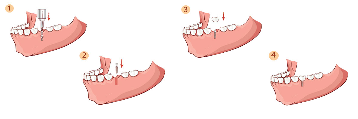 Pomona The Dental Implant Procedure