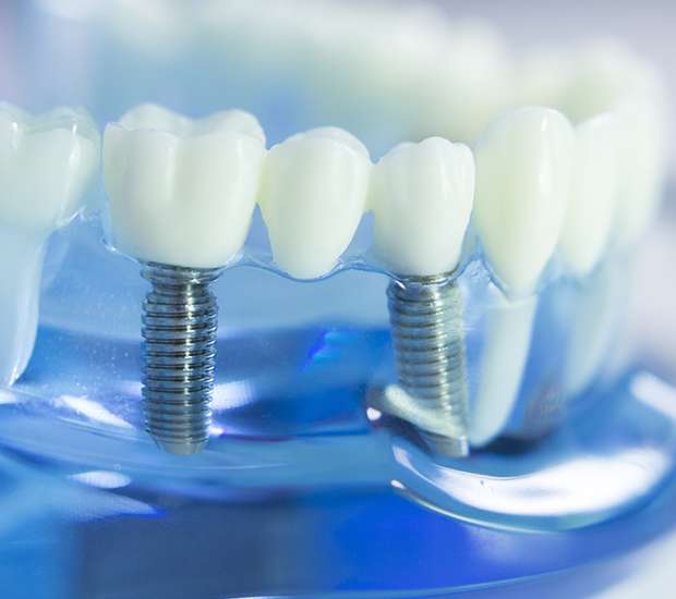 Pomona Dental Implants