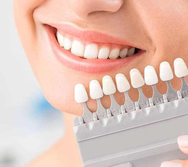 Pomona Dental Veneers and Dental Laminates