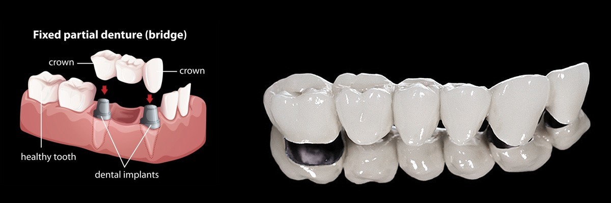 Pomona Dentures