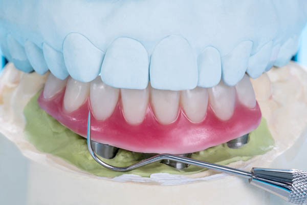 Implant Supported Dentures Pomona, CA
