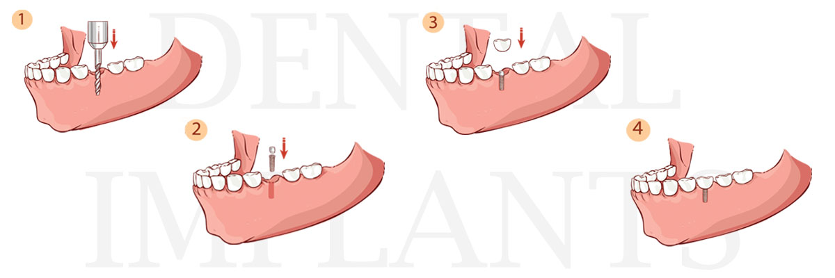 Pomona The Difference Between Dental Implants and Mini Dental Implants