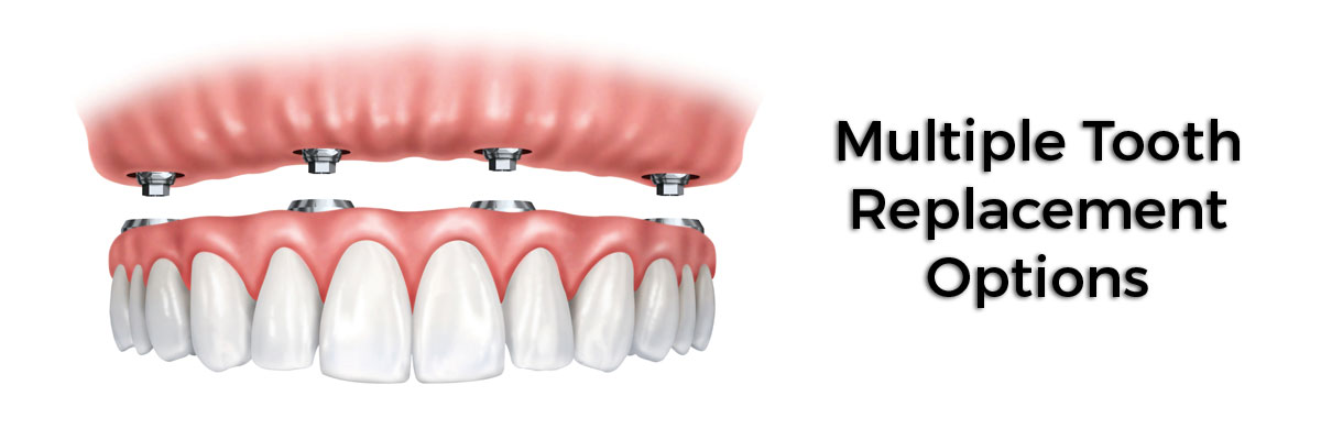 Pomona Multiple Teeth Replacement Options