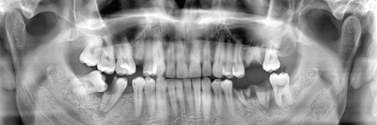 Pomona Options for Replacing Missing Teeth