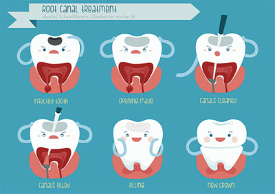 A Root Canal Dentist In Pomona: Explaining The Basics Of A Root Canal