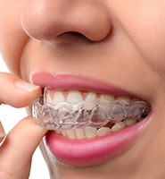 Clear Aligners - Almost Invisible Braces Pomona, CA