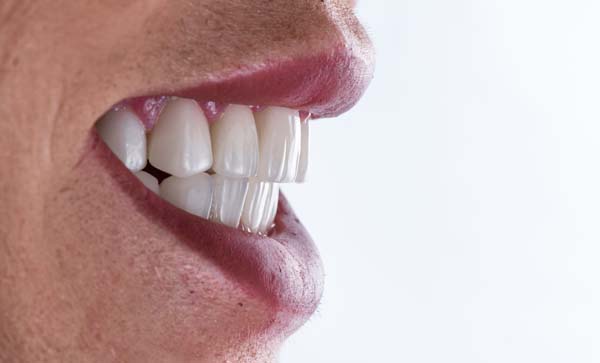 The Role Veneers Play In A Smile Makeover