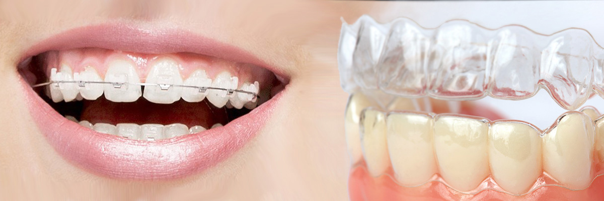 Pomona Which is Better Invisalign or Braces