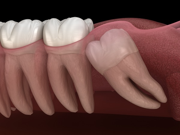 wisdom tooth extraction Pomona, CA